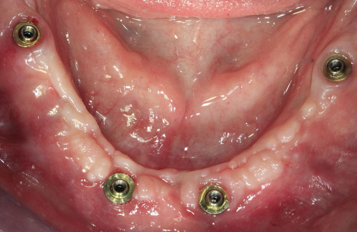 Intraoral view of four multi-unit abutments on a healed mandibular arch, prepared for a final impression.