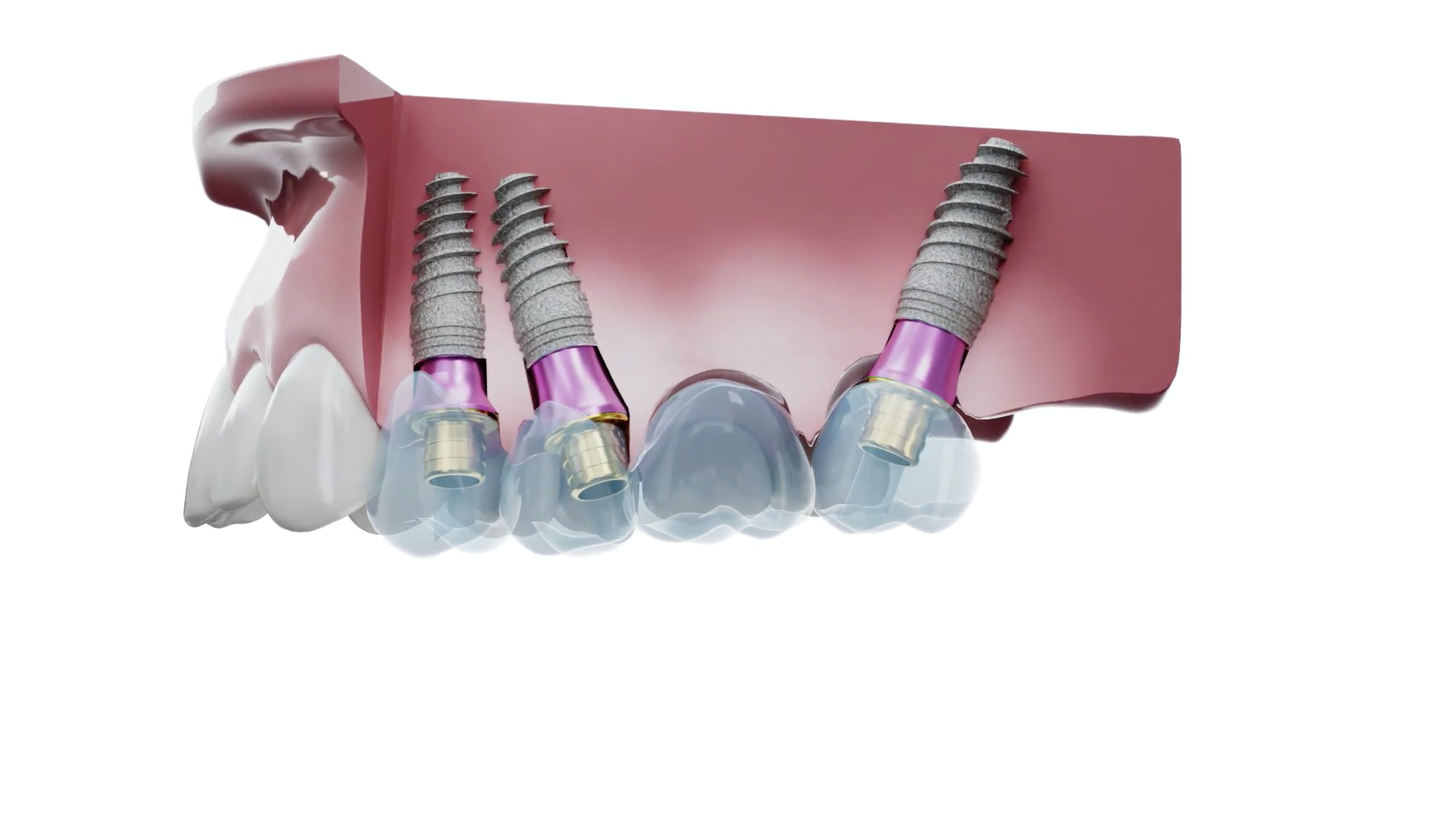 Diagram showing XGATE V-Type abutment accommodating implant divergence up to 40 degrees