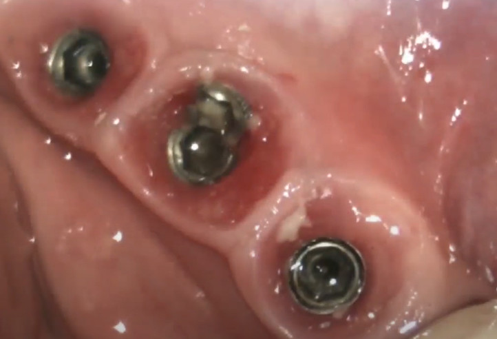 Deposits at the implant-abutment interface, difficult to access for cleaning without prosthesis removal