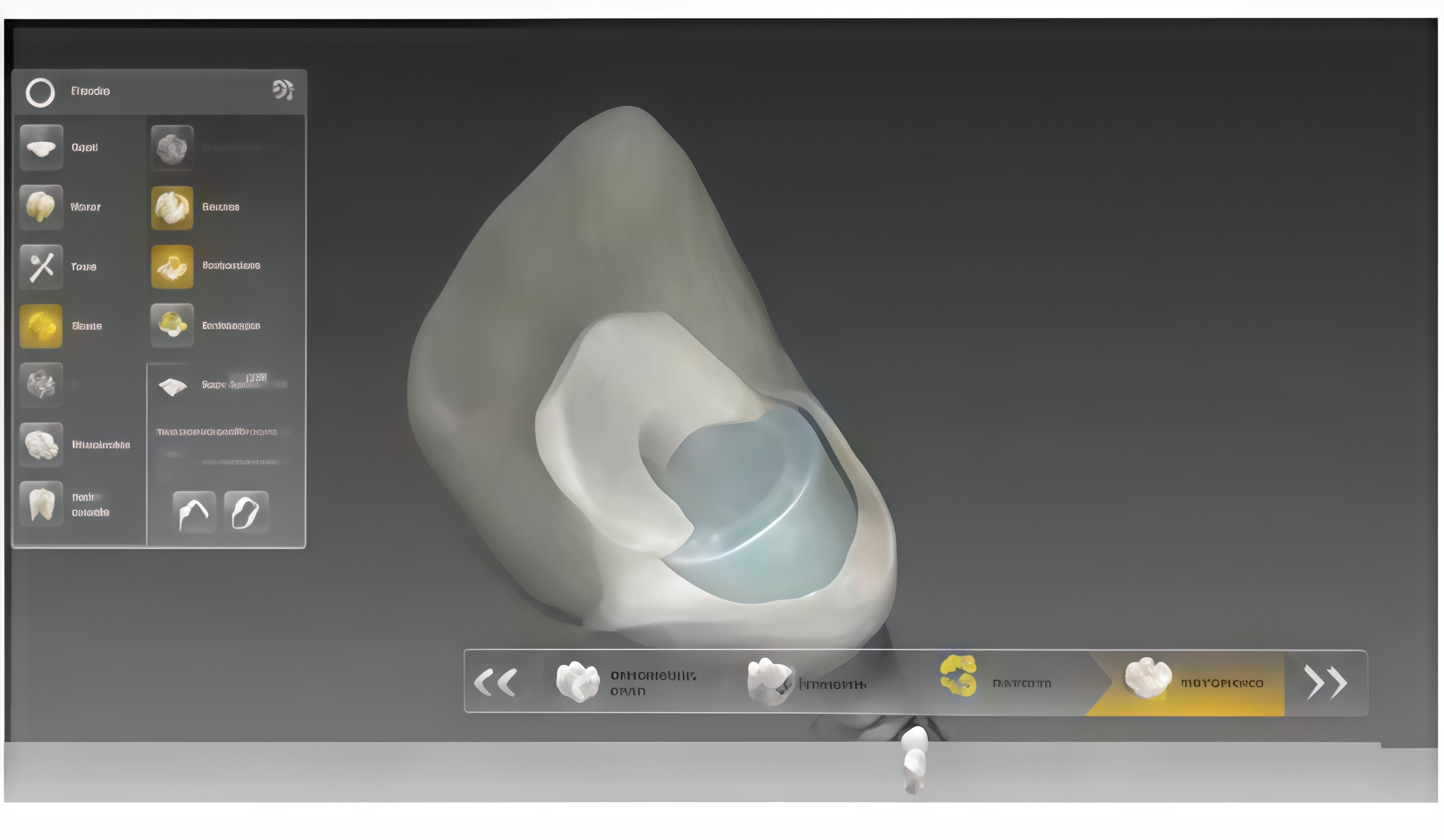 Digital design of the definitive crown and custom abutment displayed in the CAD environment.