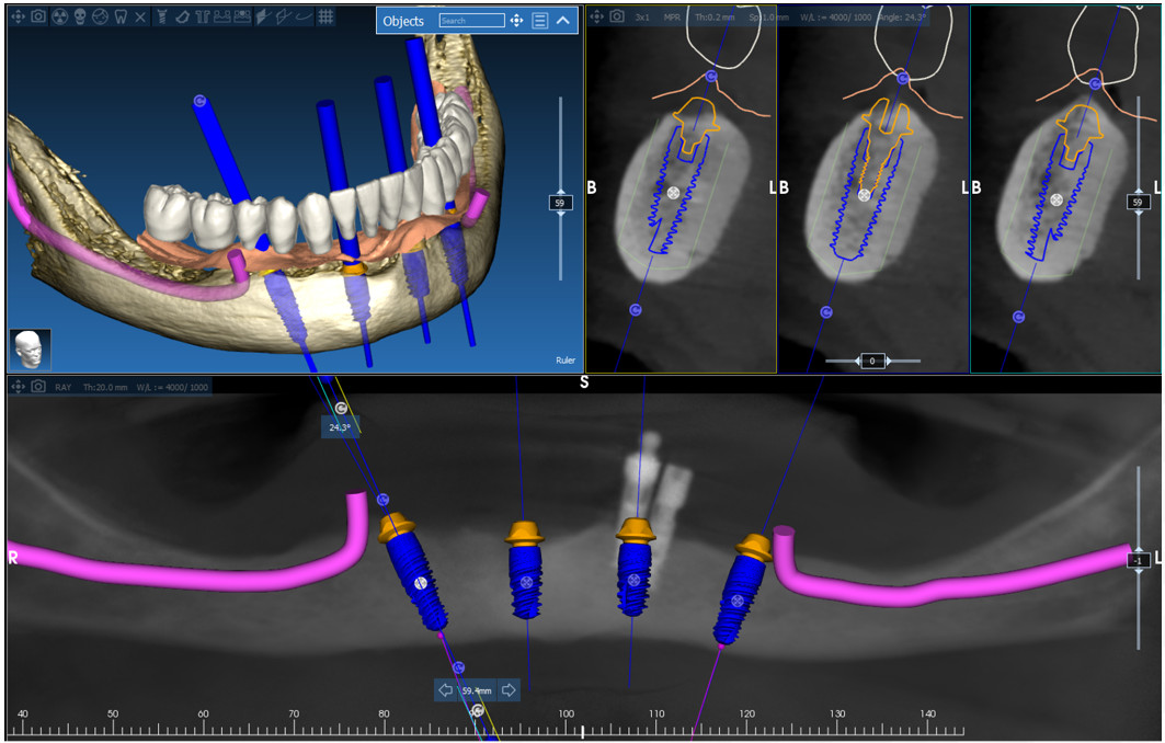 3D digital planning software showing dental implant positioning with cross-sectional views and virtual prosthetic design