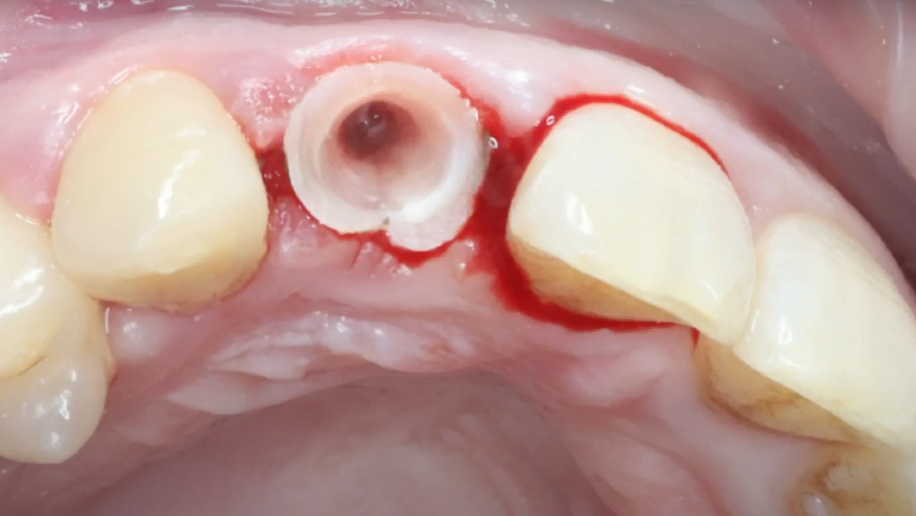 A tooth root drilled from the inside, prepared for division and removal of the palatal part of the root