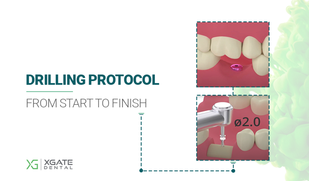 XGate Dental Implant Drilling Protocol Step-by-Step Guide