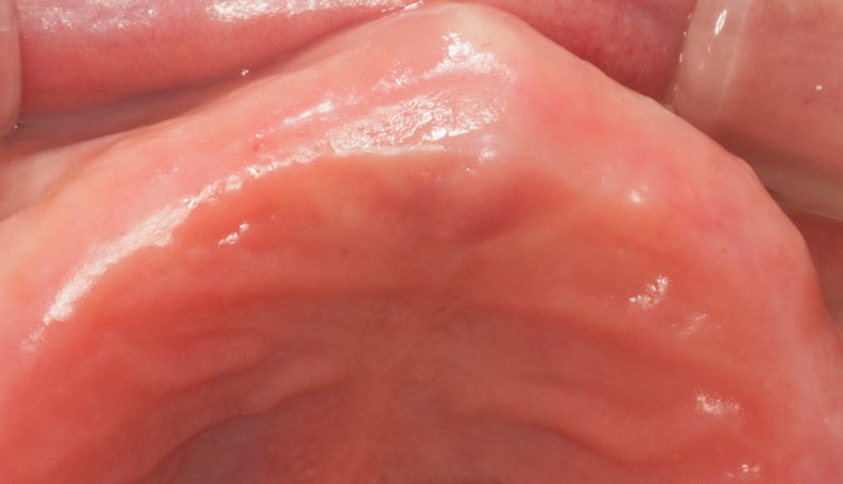 Edentulous jaw showing wide alveolar ridge with thick pink keratinized gingiva before dental implant placement