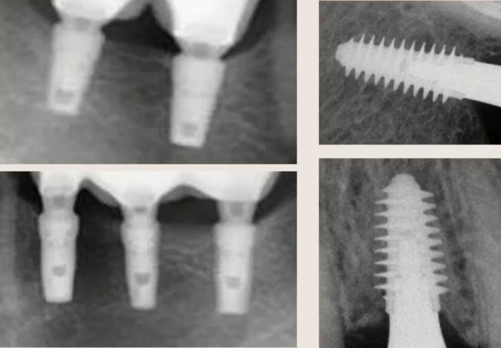 Examples of successful long-term outcomes for cortical (10 years, left) and cancellous
