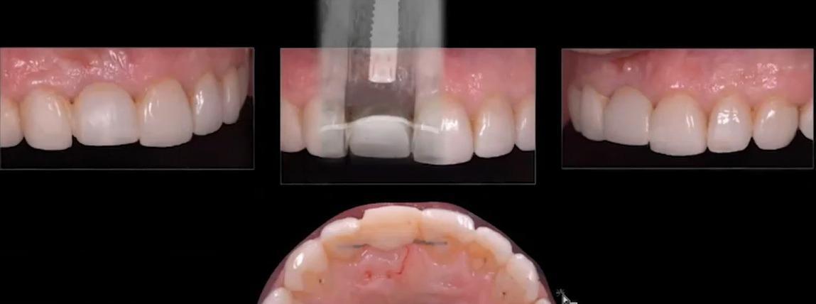 External view of the temporary anterior crown with a radiographic overlay indicating implant position.