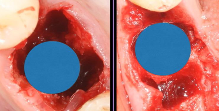 Before and after comparison of tooth extraction socket showing bone preparation for immediate implant placement procedure