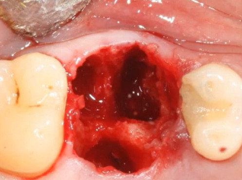 Fresh extraction socket showing inter-root septum and surrounding bone tissue prepared for immediate implant placement