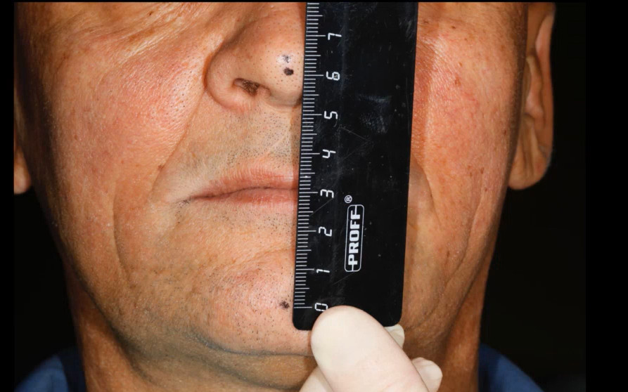 Black measuring ruler held vertically against patient's face during clinical assessment