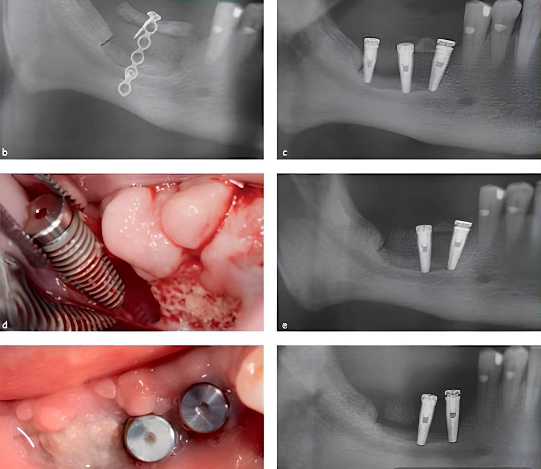 X-ray and clinical images showing dental implant placement after unsuccessful bone augmentation procedure