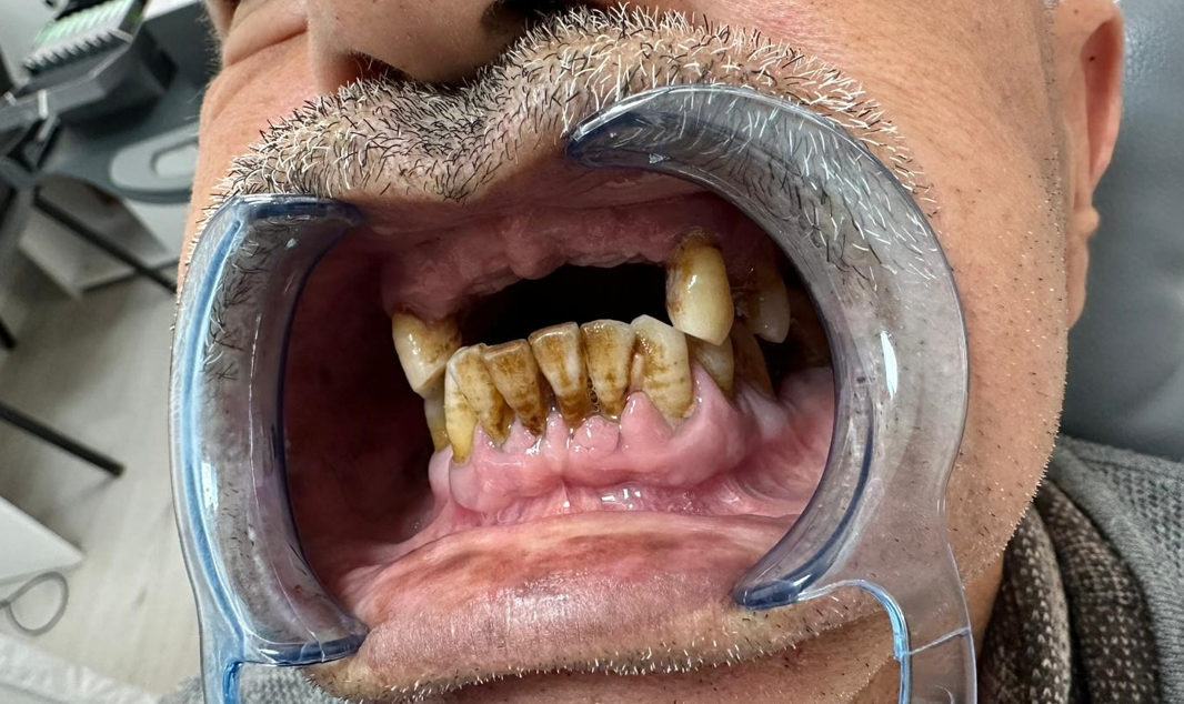 Intraoral frontal view of the patient's failing dentition with mobile, carious teeth in both jaws.