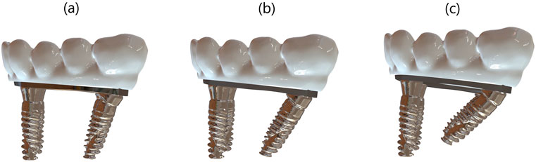 Three distal implant configurations showing 15°, 30°, and 45° angulations with corresponding bar framework and prosthetic superstructure in Full-arch restoration FEA model