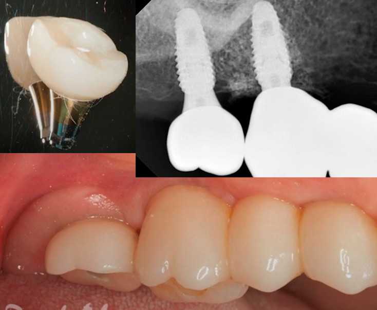Dental implant restoration showing final zirconia crown and bridge placement