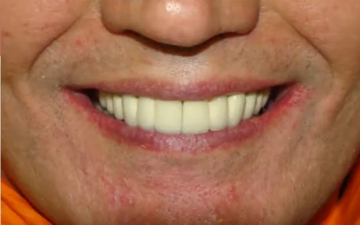 Patient smiling showing completed dental implant restoration with natural looking white teeth