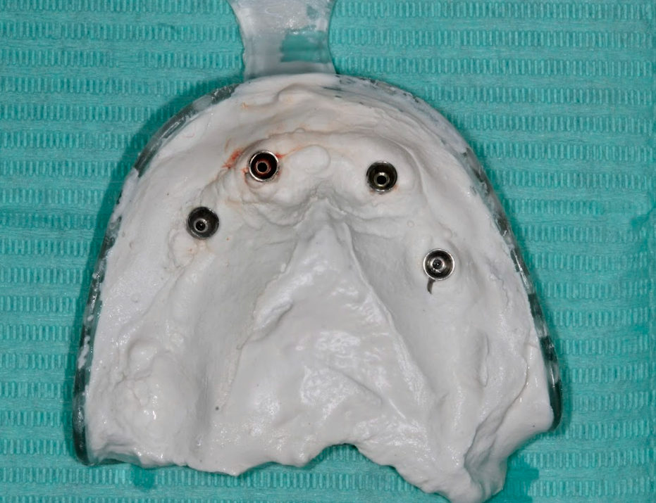 The final impression tray showing the captured positions of the four multi-unit abutments.