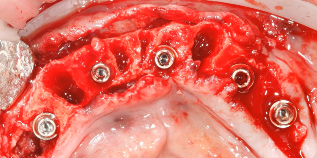 Five dental implants placed in upper jaw bone immediately after tooth extraction showing optimal distribution