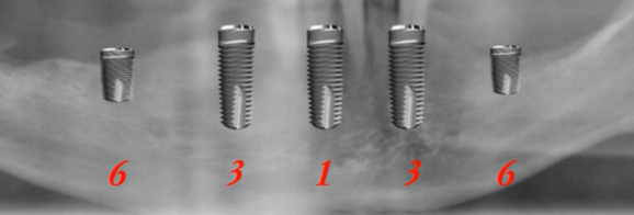 Five dental implants arranged in arch formation showing immediate full-arch restoration implants with center reinforcement unit