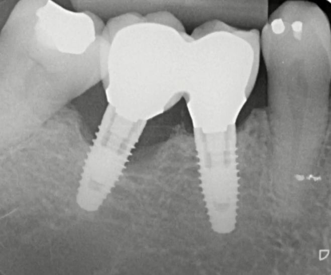 Forcing the restoration with internal stress resulted in bone resorption around one of the implants (left)
