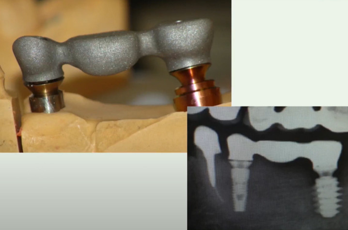 An example of a framework that did not pass the Sheffield test: on the left abutment a gap is visible between the framework and the abutment base