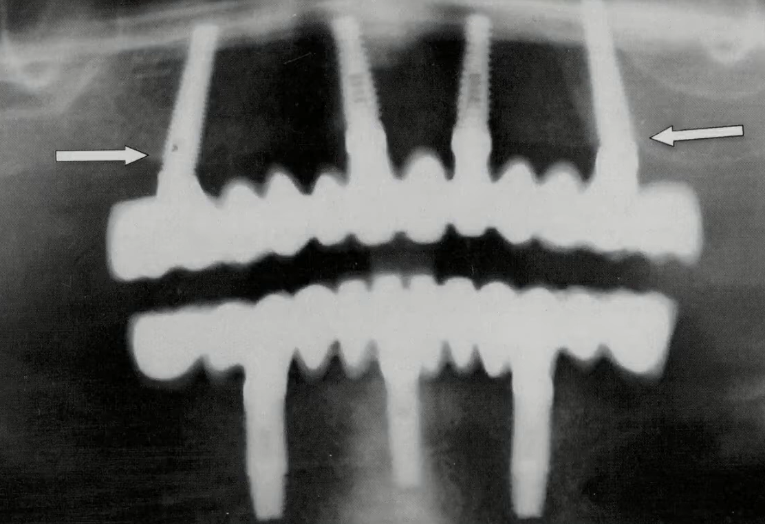 Minimal dental implants for full-arch upper and lower jaw restoration