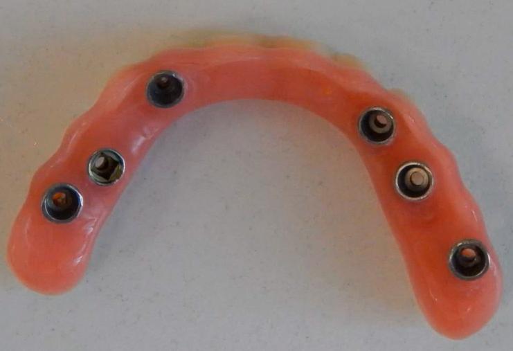 Mandibular full-arch restoration showing screw access channels and compensated implant divergence.