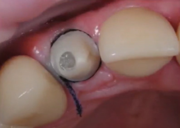 Using gingival floss to protect the subgingival space from penetration of cement residues
