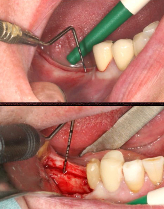 Clinical measurement of gingival tissue thickness using periodontal probe at dental implant site showing thin and thick biotypes
