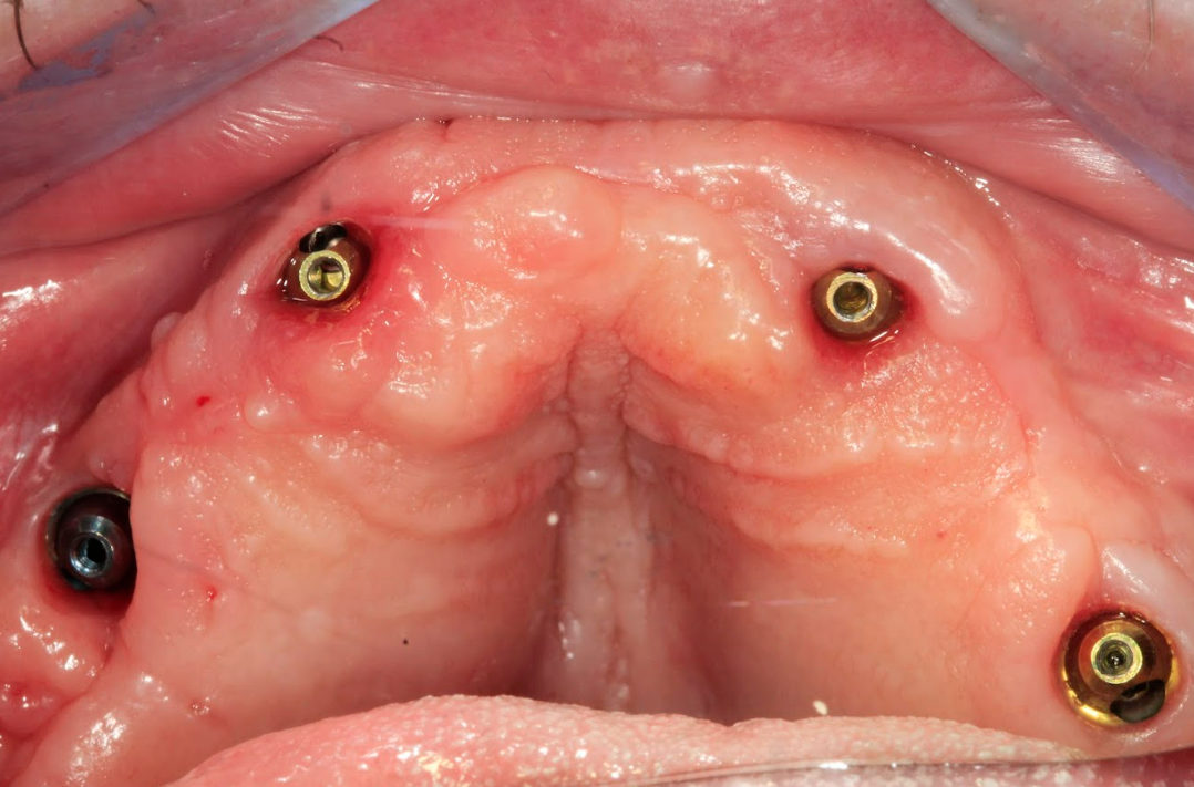 Healed maxillary gingiva after four months of osseointegration, showing all four XGATE MUAs in place.