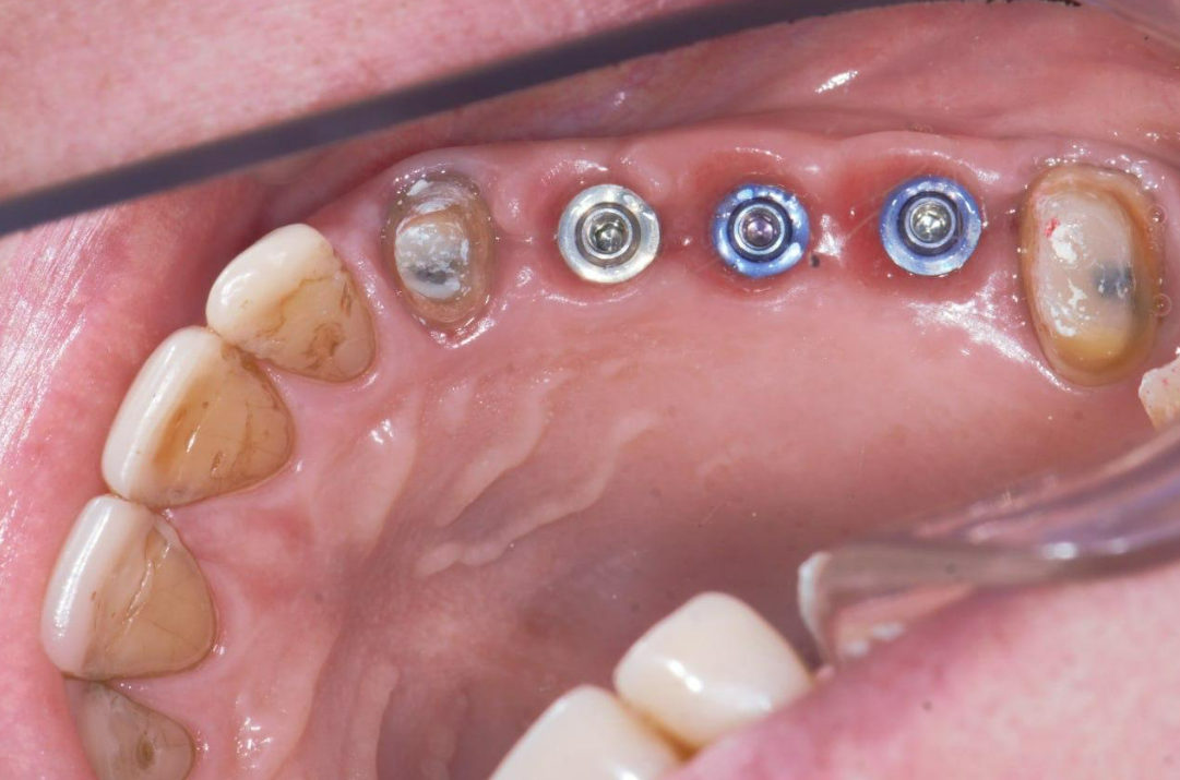 Three healing abutments installed in upper jaw between natural teeth during implant integration phase