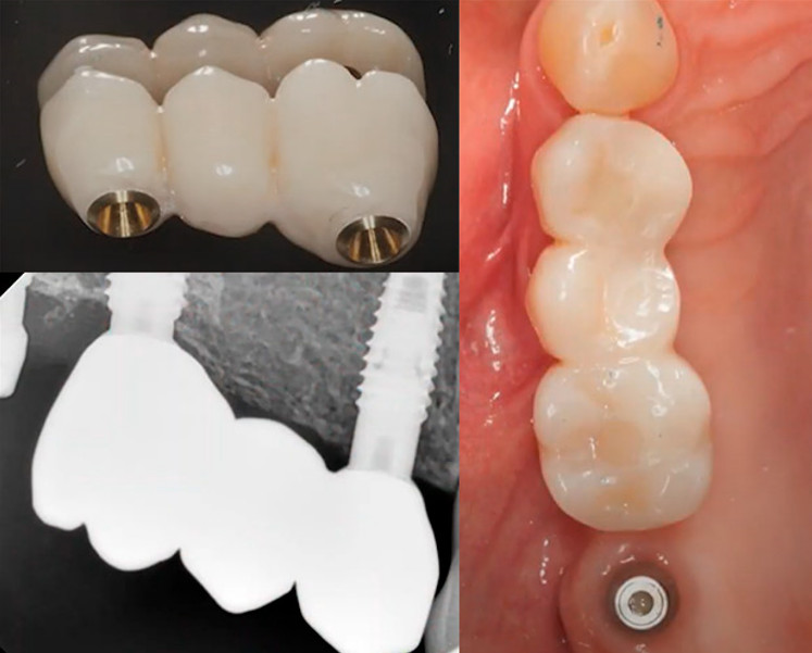 Healing cap and shortened bridge stabilizing spinning dental implant during recovery