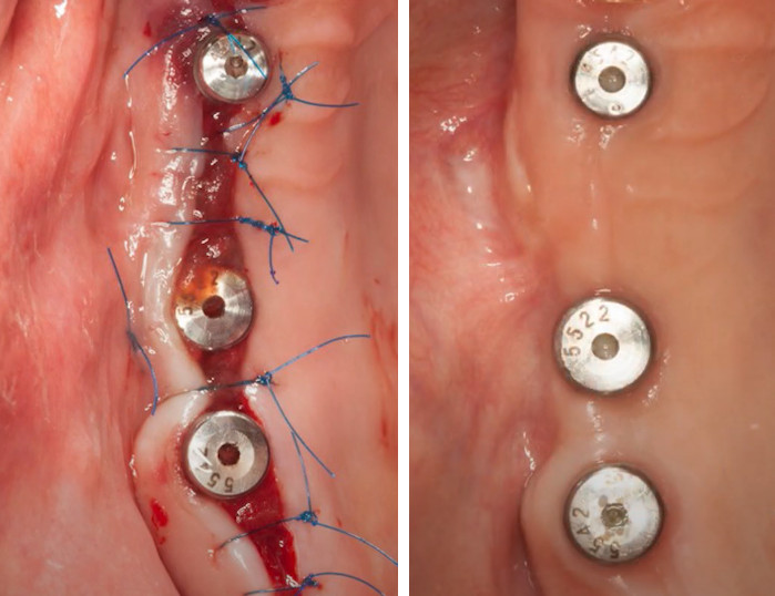 Dental implant healing caps shown immediately post-surgery and after three months