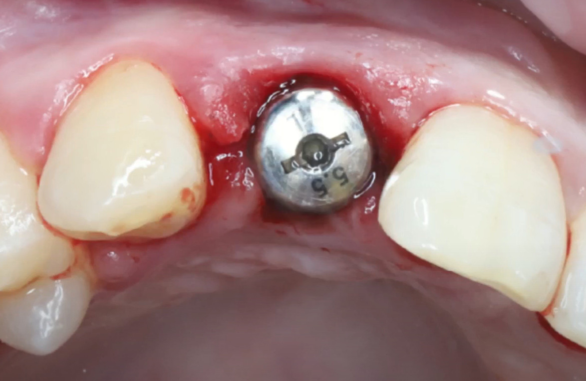 A temporary prosthesis is made from the coronal part of an extracted tooth