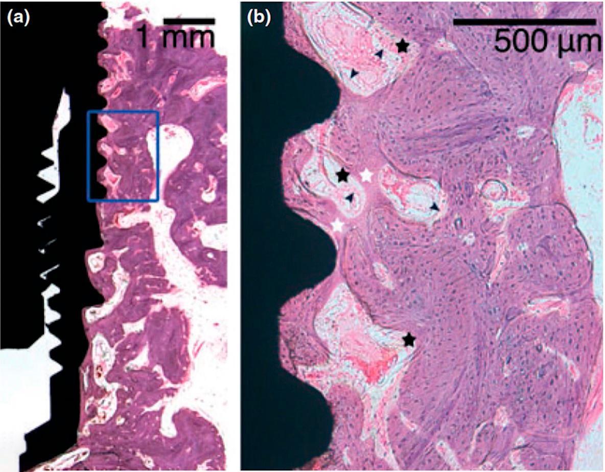 Microscopic view of tissue healing around dental implant showing early osseointegration