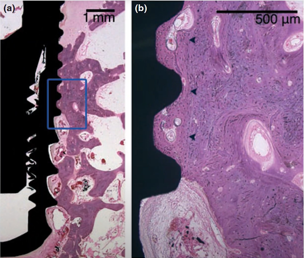 Microscopic view of bone tissue interface around dental implant osteotomy margins