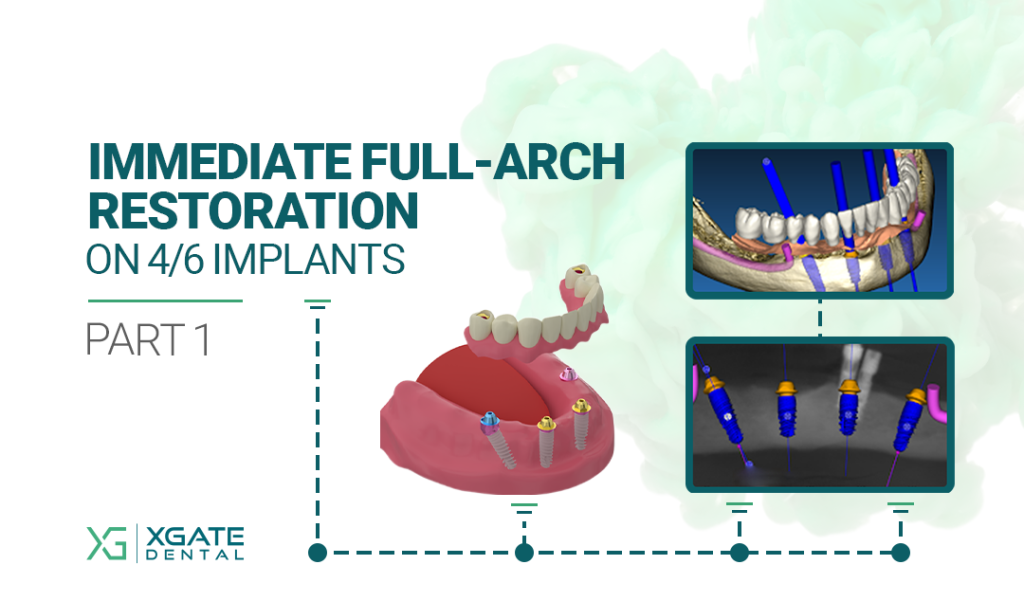 Immediate Full-Arch Restoration on 4/6 Implants. Part 1