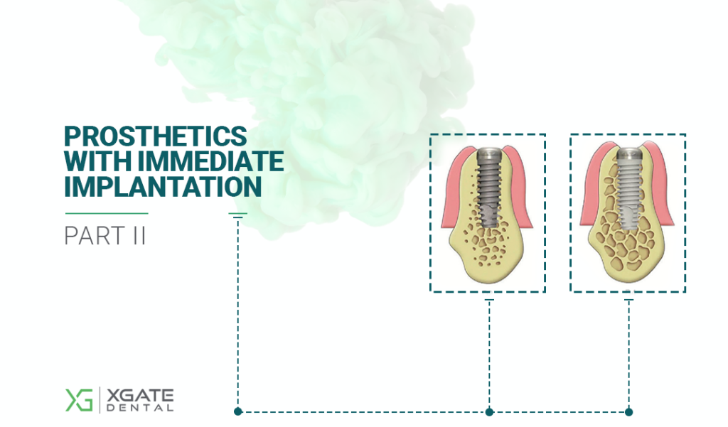 Prosthetics with immediate implantation. Part 2