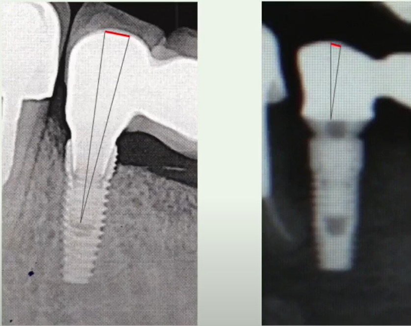 Difference in deviation of the installed restoration when using screw retention to an implant (left) and to a multi-unit abutment (right)