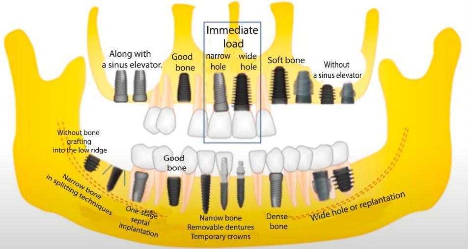 Implant designs vary depending on the placement site and bone density
