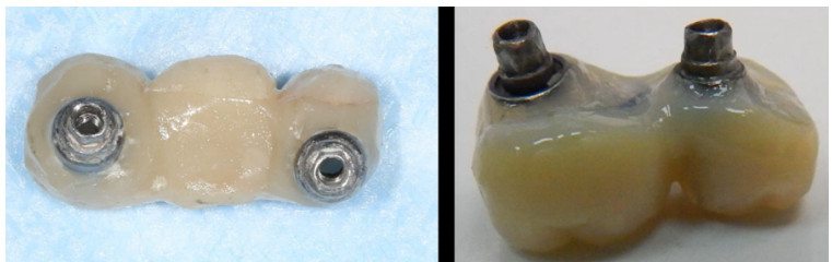 Provisional implant-level screw-retained restorations with significant axial divergence.
