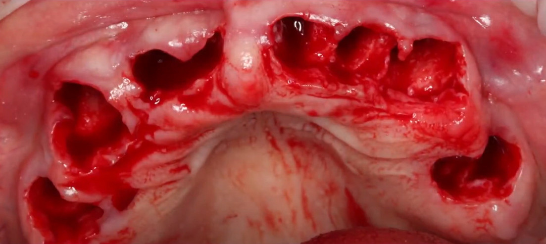 The condition of the patient's upper jaw gums immediately after the atraumatic extraction of all teeth.