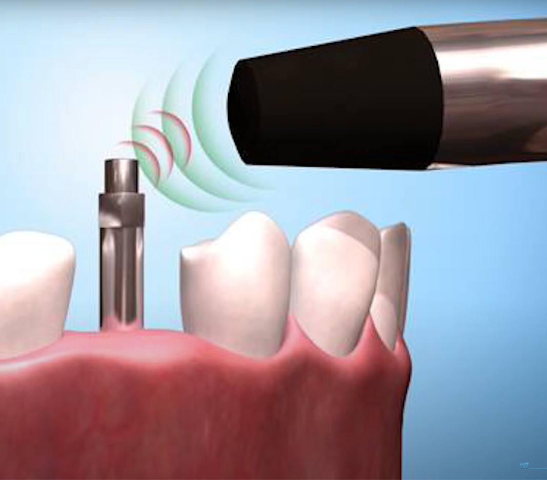 Model demonstrating resonance frequency testing on spinning dental implant stability measurement