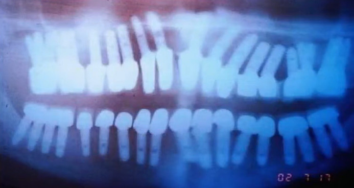 Dental implant placement error showing insufficient spacing between multiple implants