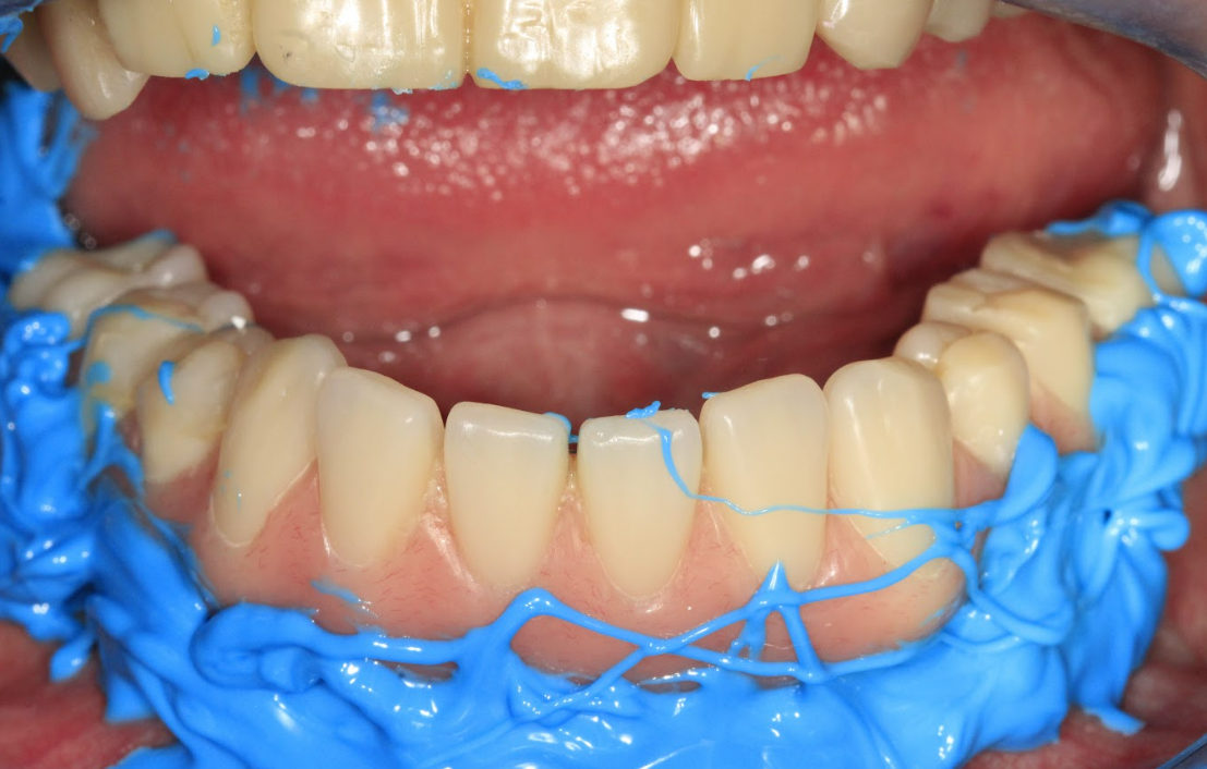 A clinical photo demonstrating the indirect reline technique using a light-body impression material to capture the healed gum contours.