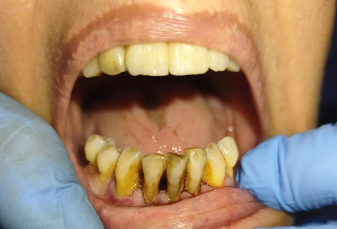 Frontal intraoral view of the patient's failing dentition before treatment.