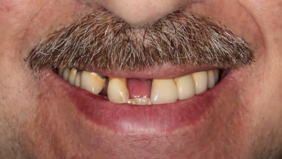 Panoramic dental X-ray showing the patient's upper jaw, revealing significant tooth loss and the initial bone condition before surgery.