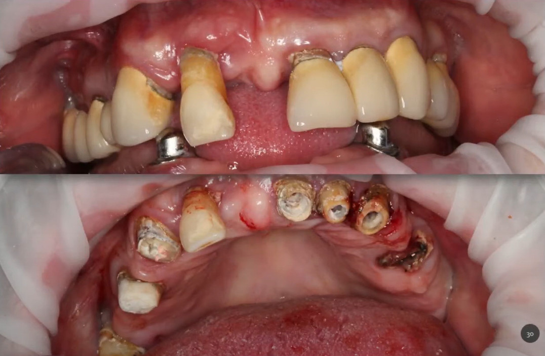 Occlusal view of the patient's upper arch, displaying the remaining hopeless teeth before extraction.