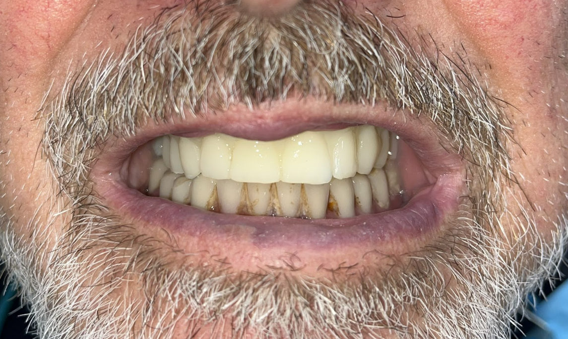 Initial prosthetic try-in to assess tooth morphology and occlusion.