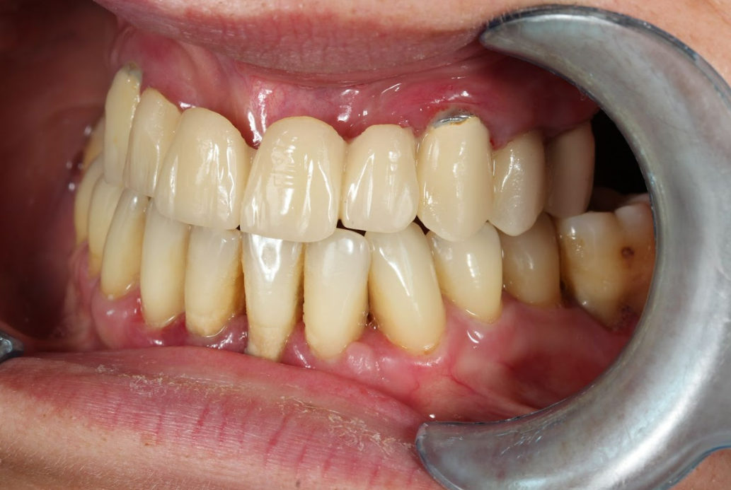 Initial clinical situation showing existing metal-ceramic restoration in maxilla before treatment, patient presenting with aesthetic and functional complaints