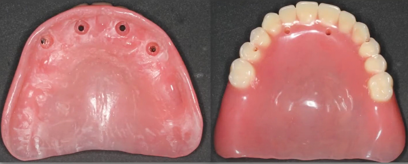 Frontal view of the tissue-supported temporary denture before its conversion to a screw-retained provisional prosthesis.