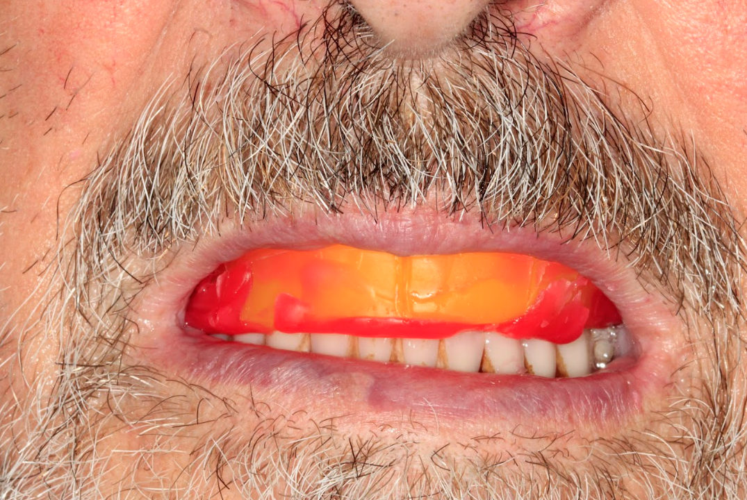 Intraoral check of the vertical dimension of occlusion using the wax rim and verification jig.
